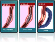 怎樣治療冠心??？